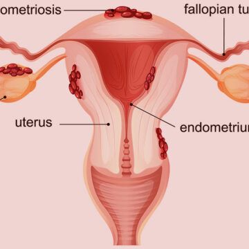 grafički prikaz endometrioze i Čokoladne Ciste