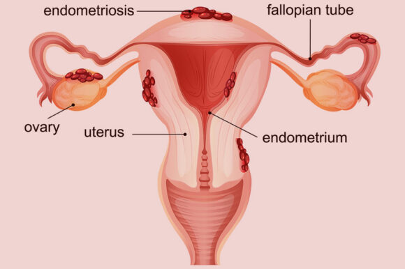 grafički prikaz endometrioze i Čokoladne Ciste