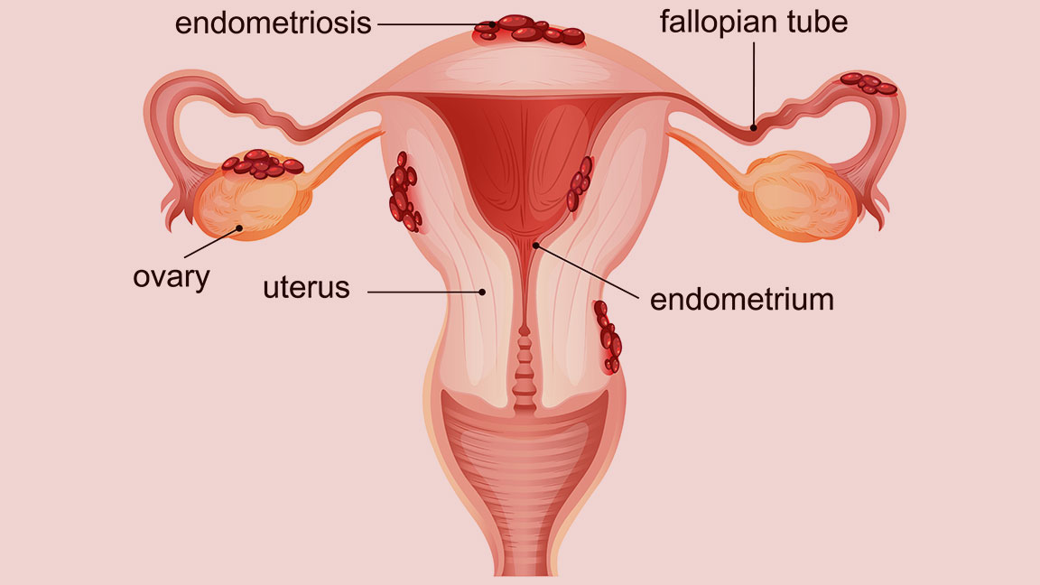 Endometrioza-i-Čokoladne-Ciste grafički prikaz endometrioze i Čokoladne Ciste